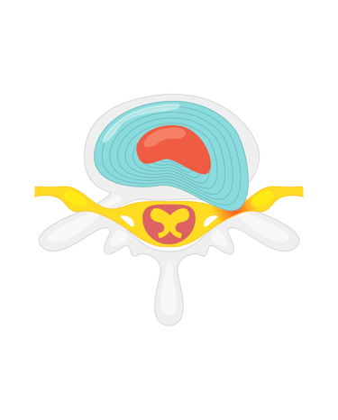 disque-hernie-osteopathe