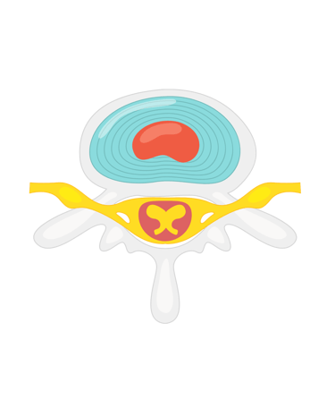 hernie-discale-osteopathe-strasbourg