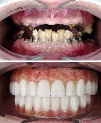 Patient with broken teeth restored with permanent All-On-4 crystal clear bridge