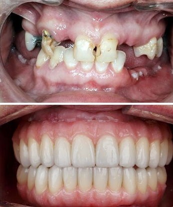 Full mouth dental implants replacing damaged teeth with fixed ceramic bridge