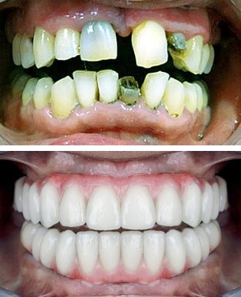 All-On-4 smile transformation using durable acrylic hybrid prosthesis