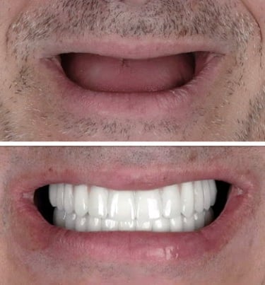 Patient receives full arch restoration with immediate load All-On-4 bridges