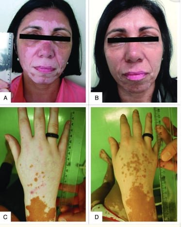 Tratamiento para vitiligo