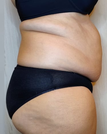 Fianchi e addome PRIMA del Trattamento Lipolite Corpo