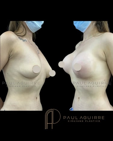 Cirugía de senos Bogotá | Cirujano Plástico mamoplastia