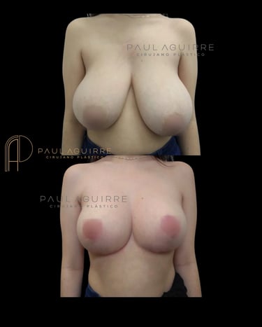 Cirujano plástico de senos Bogotá | Levantamiento