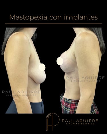 Cirujano plástico de senos Bogotá | Levantamiento con implantes
