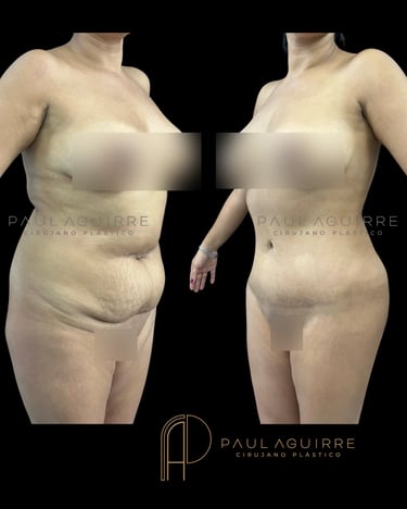 Cirujano plástico de contorno corporal Bogotá | Abdominoplastia