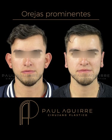 Cirujano plástico de orejas Bogotá | Otoplastia