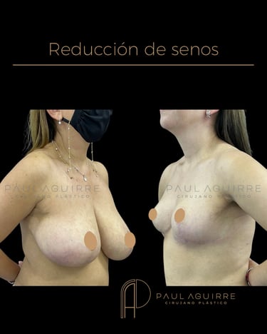 Mejor cirujano plástico de reducción de senos Bogotá | Mamoplastia reductora