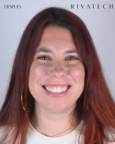 Dientes blancos después de blanqueamiento dental profesional
