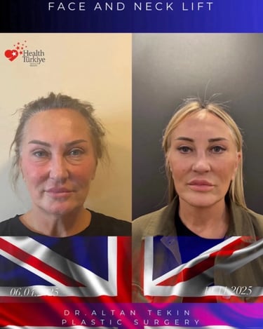 facelift before after
