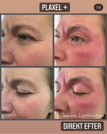 a person before and after plaxel plus