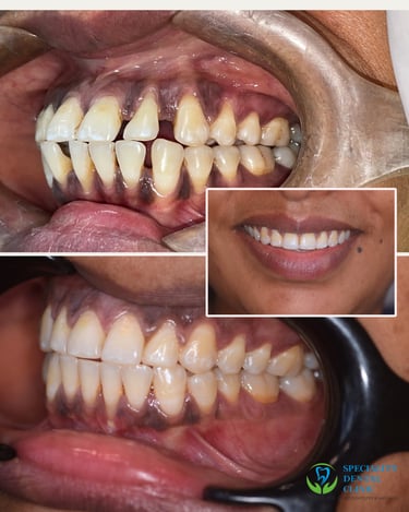 gaps in teeth closed using invisble braces by best orthodontist in malad west mummbai