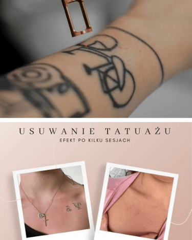 usuwanie tatuaży efekt przed po