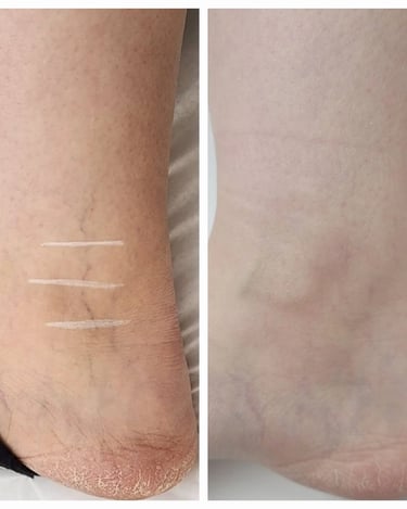 Laser vein treatment at Ariana Esthetic clinic Edmonton