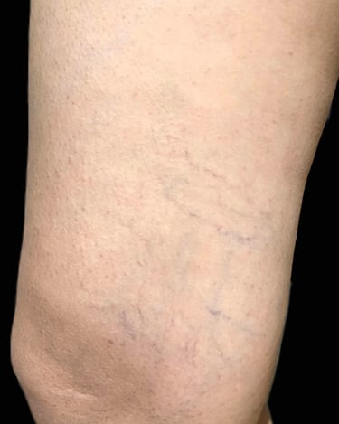 Telangiectasias treatment at Ariana Esthetic Edmonton.