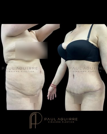 Cirujano plástico lipectomía Bogotá | Abdominoplastia
