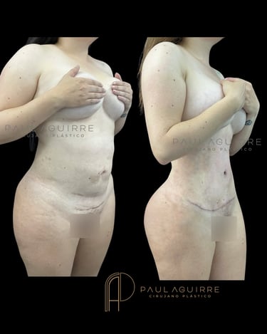 Abdominoplastia Bogotá | Cirujano Plástico de abdomen