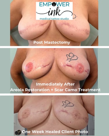 Before and after post-mastectomy areola and nipple tattoos