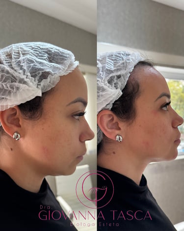 Antes e depois de preenchimento de queixo com melhora da projeção e harmonização do perfil facial