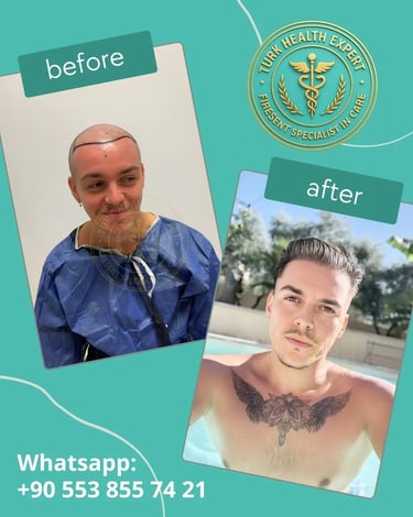 before and after hair transplantation turkey