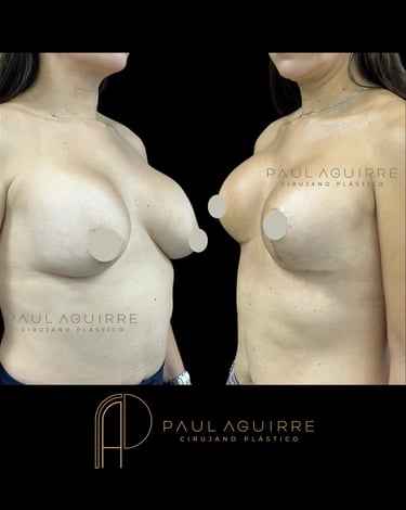 Cirujano plástico de senos Bogotá | Cambio de implantes
