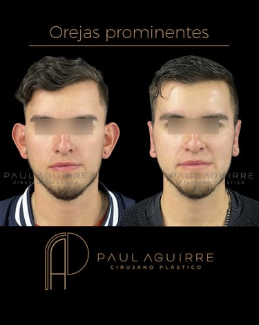 Cirujano plástico de orejas Bogotá | Otoplastia