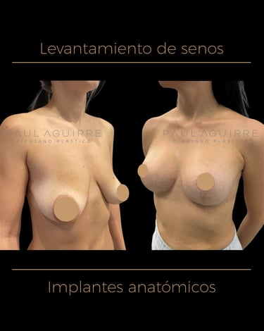 Cirujano plástico de levantamiento de senos Bogotá | Mastopexia con implantes