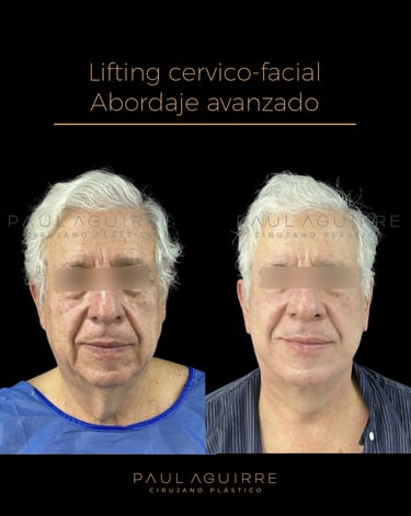 Cirujano plástico de rejuvenecimiento facial Bogotá | Lifting cervicofacial