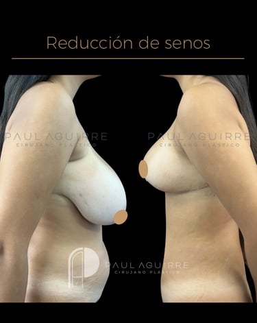 Cirujano plástico de reducción de senos Bogotá | Mamoplastia reductora