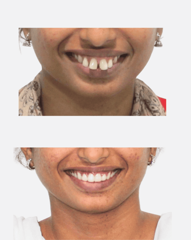 Smile Transformation