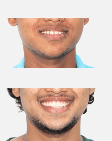 Before & After Invisalign Transformation