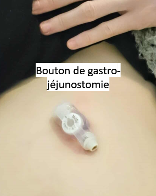 bouton de gastro-jéjunostomie