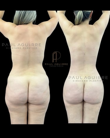 Cirujano plástico de lipo Bogotá | Lipoescultura