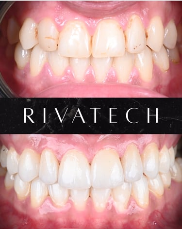 Dental veneers before and after transformation showing white, straight teeth for a smile makeover.