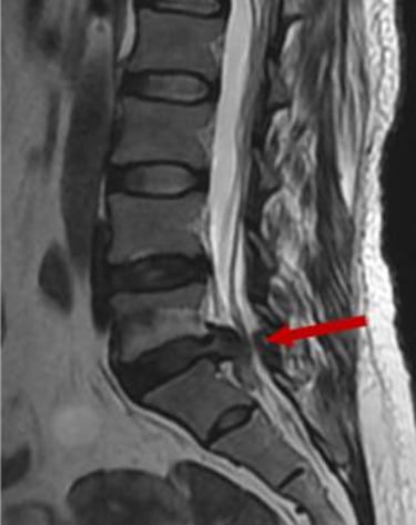 imagen de RMN de antes y después de la reabsorción de una hernia discal