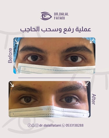 رفع وسحب الحاجب
