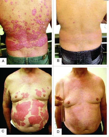 tratamiento para psoriasis