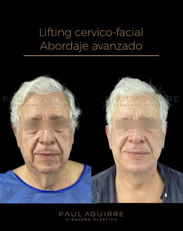 Cirujano plástico de rejuvenecimiento facial Bogotá | Lifting cervicofacial