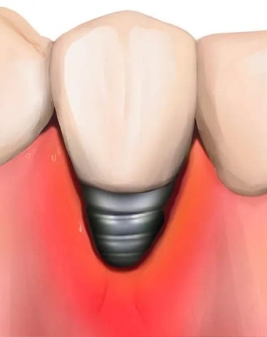 peri-implantitis risk loss dental implant hygiene-precision.com