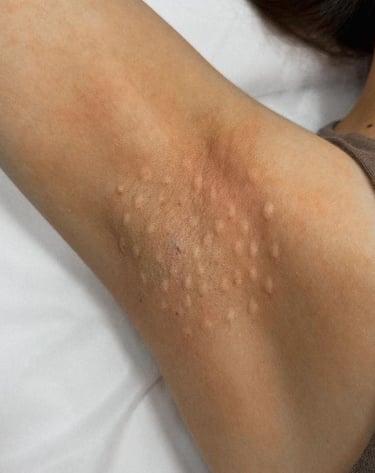 tratamento hiperidrose em bh