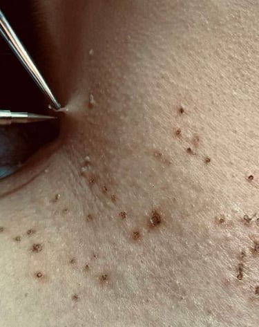 remover verrugas em bh