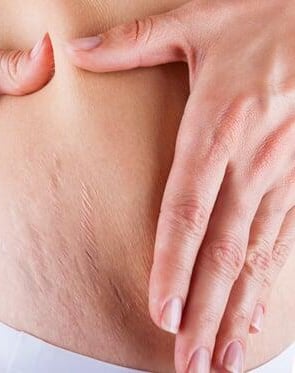 Peau harmonisée après camouflage des vergetures féminines.