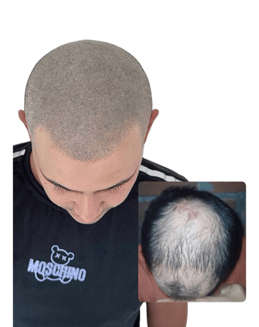 Résultat de micropigmentation capillaire effet rasé – densité naturelle.