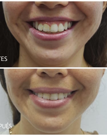 Imagen de antes y después del tratamiento con botox para corregir la sonrisa gingival