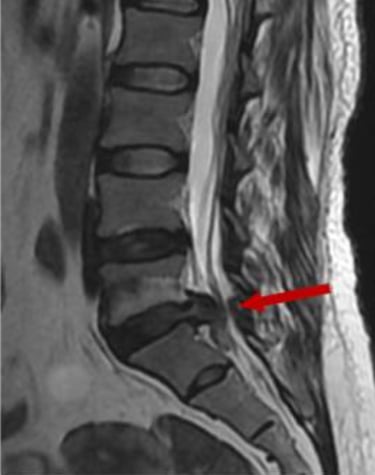 imagen de RMN de antes y después de la reabsorción de una hernia discal