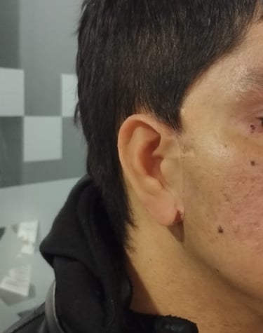 Protesis para orjas en silicona fabricada por anaplastologo clinico