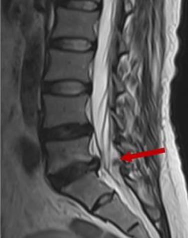 imagen de RMN de antes y después de la reabsorción de una hernia discal