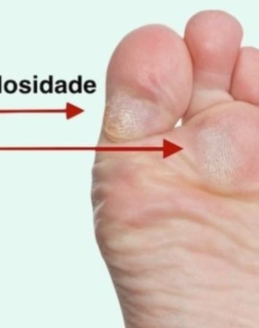 TRATAMENTO CALOS EM BH